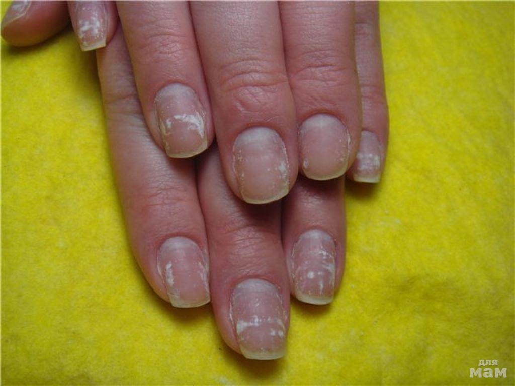 Онихолизис можно покрывать лаком. Аллергия на гель лак для ногтей.